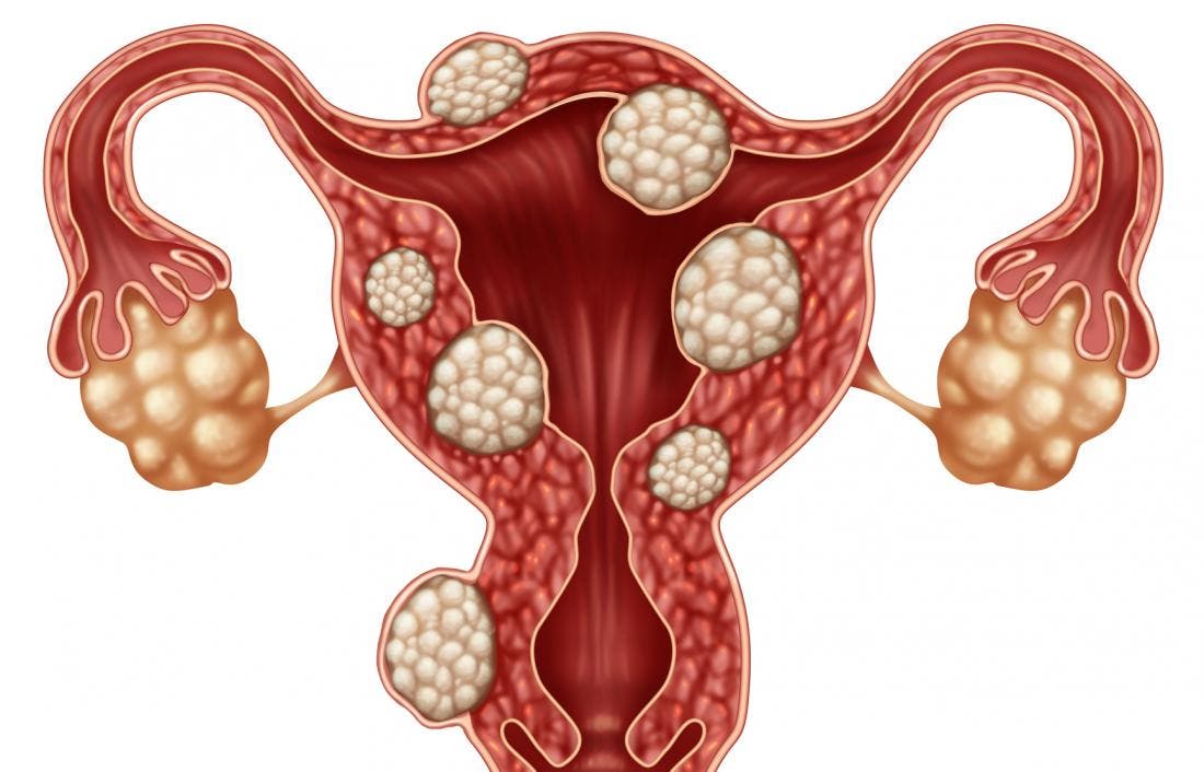What You Should Know About Uterine Fibroids in Menopause