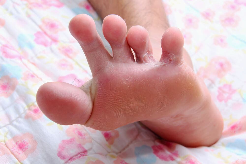 Как выглядит грибок на пальцах ног